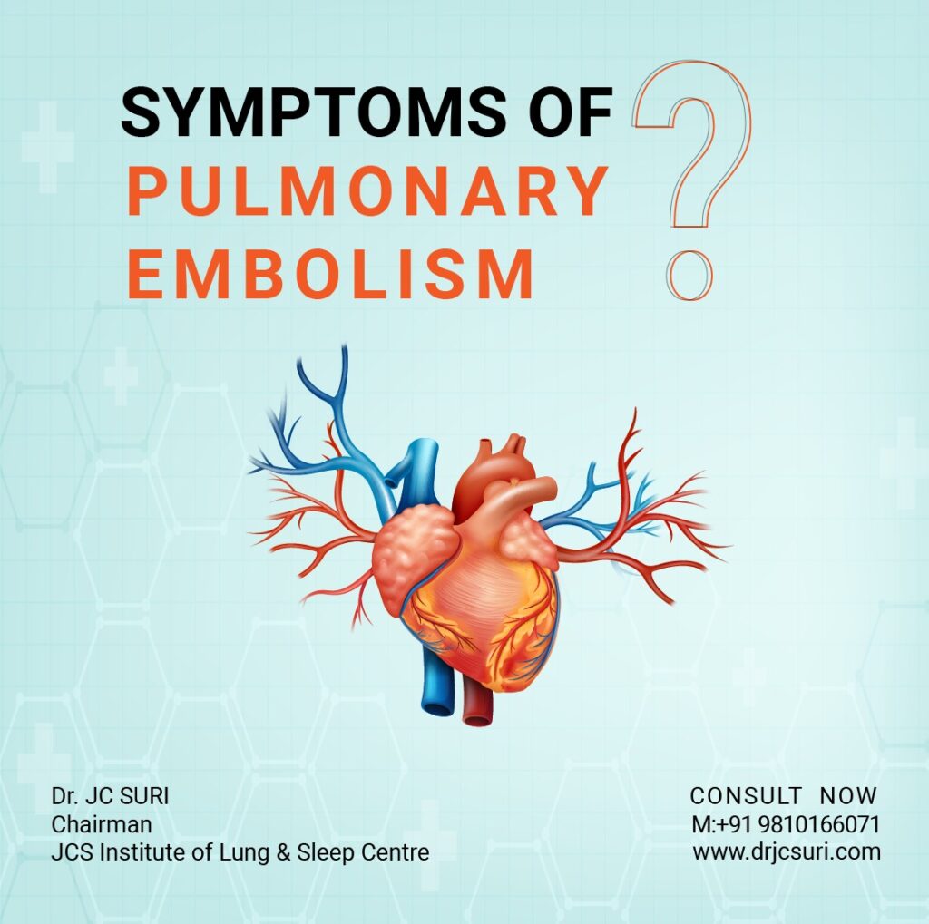 Pulmonary Embolism Explained Causes Symptoms And Treatment Nbkomputer