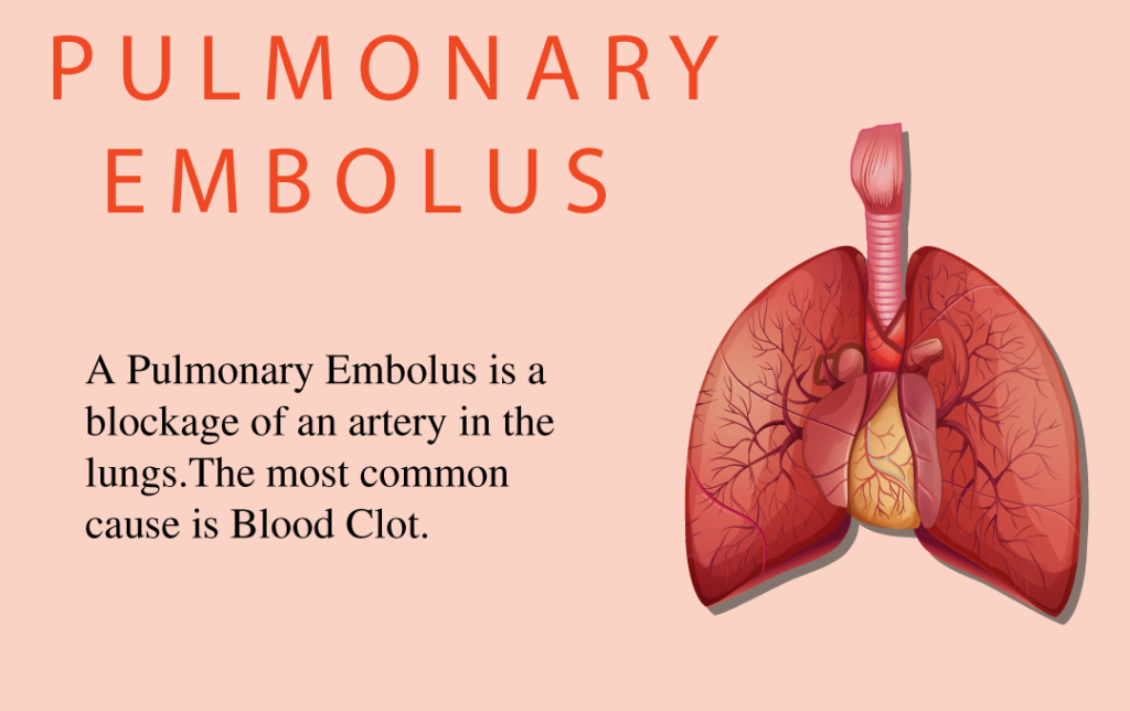 what-is-pulmonary-embolism-dr-j-c-suri