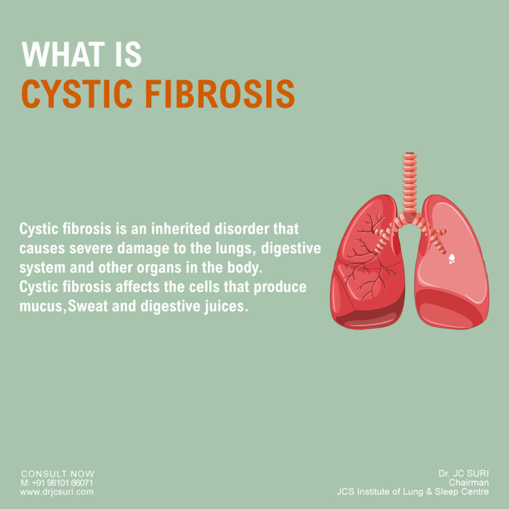 Cystic Fibrosis Cf Symptoms Causes Diagnosis And Treatment Dr J C