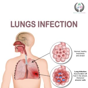 Lung Infection: Types, Symptoms, Treatment Guide