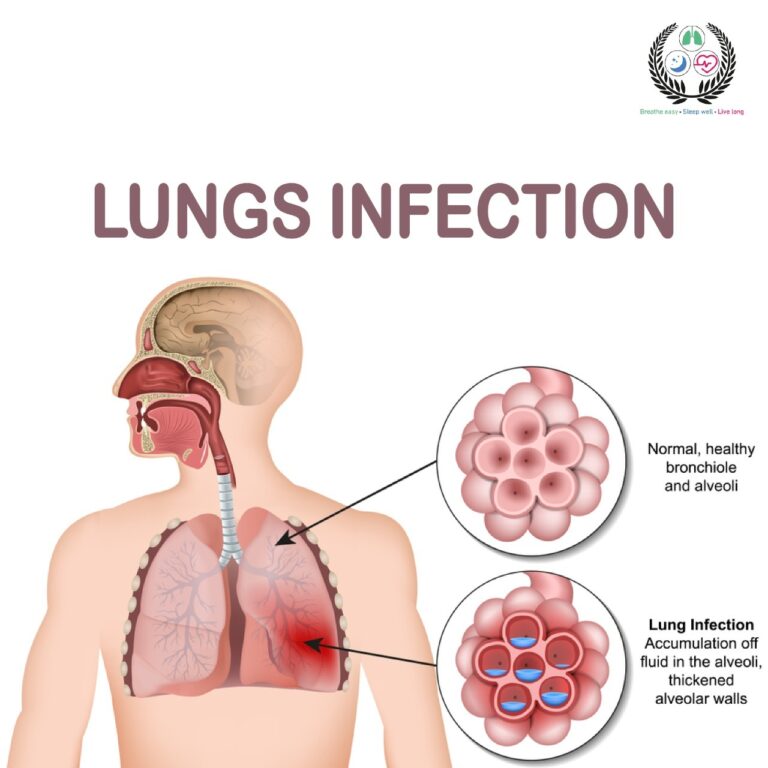 What Can A Lung Infection Feel Like